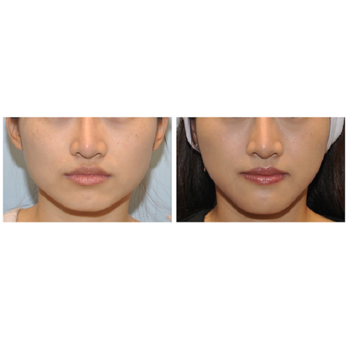 下顎骨角修順＋下巴延長