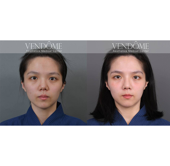 FITme 完形美 客製化3D列印矽膠假體