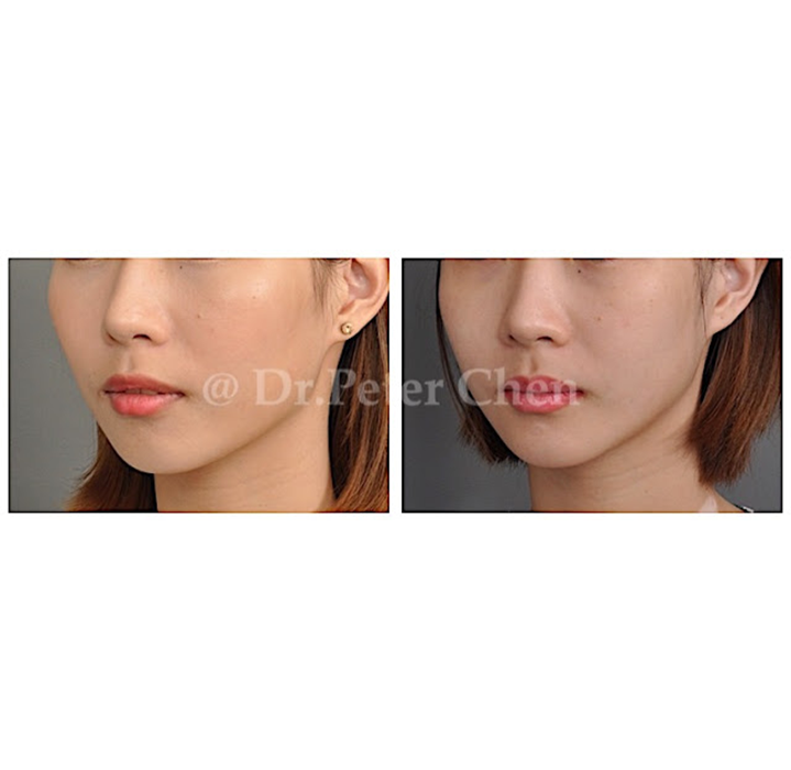 顴骨截骨內推+下巴截骨