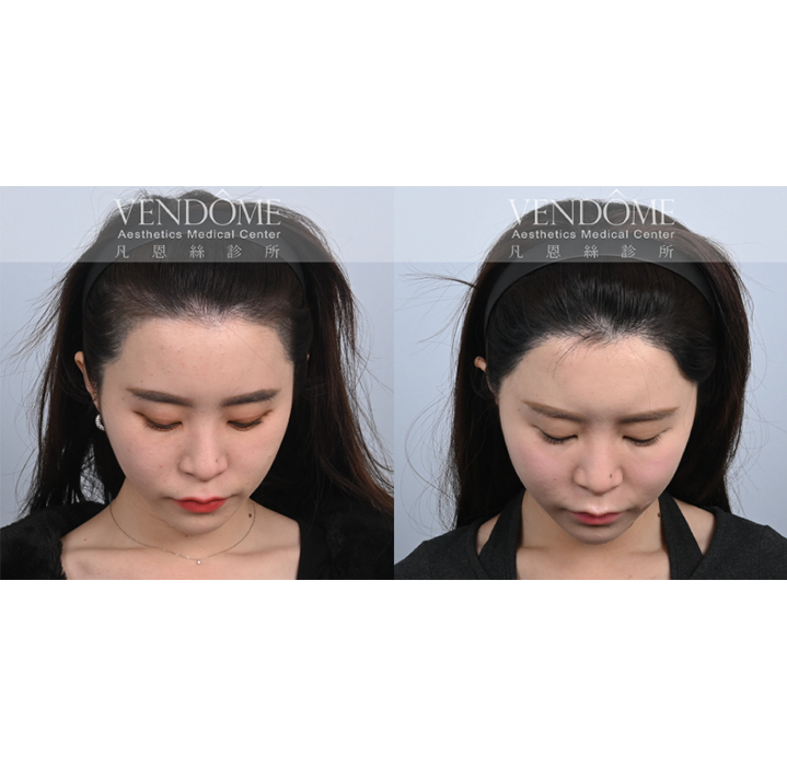 女性美型髮際線