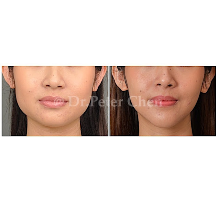 下顎骨角削骨+下巴手術