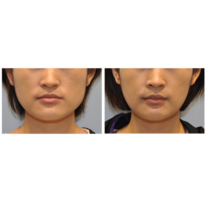 正顎+下顎骨角削骨