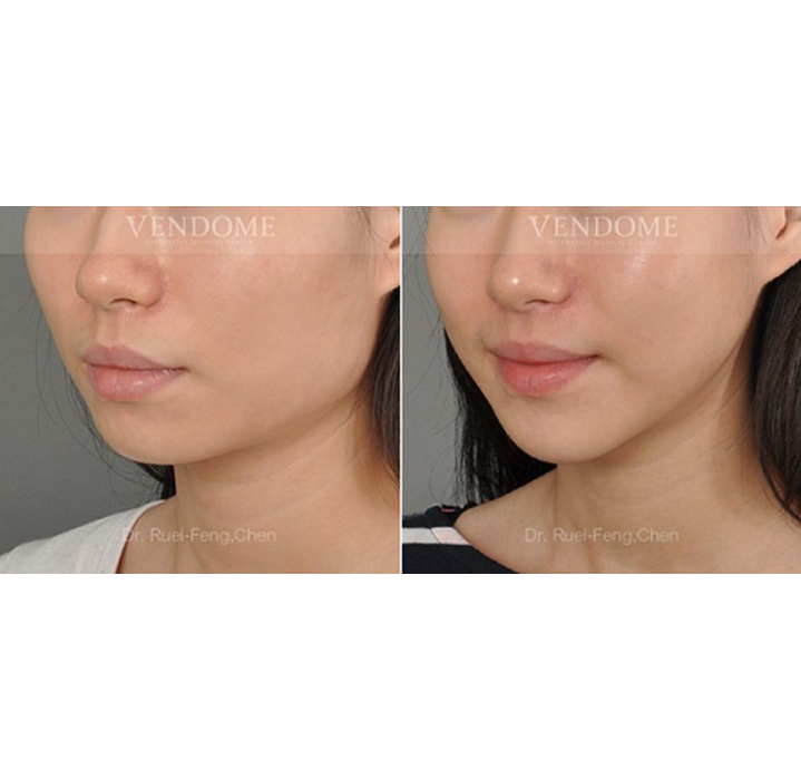 下顎骨角修順＋下巴延長