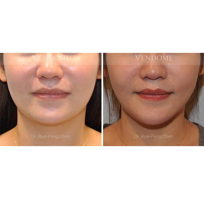 下顎骨角削骨+正顎