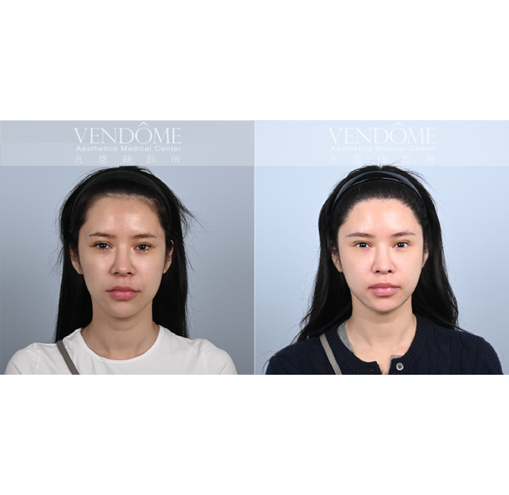 女性美型髮際線