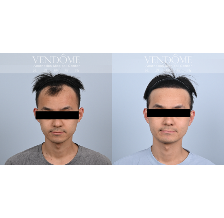 男性M型髮際線