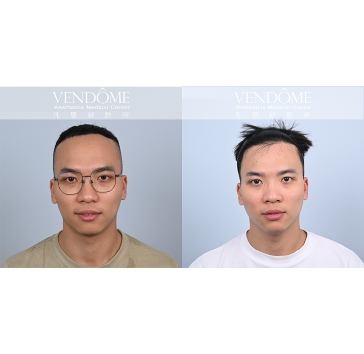 男性M型髮際線