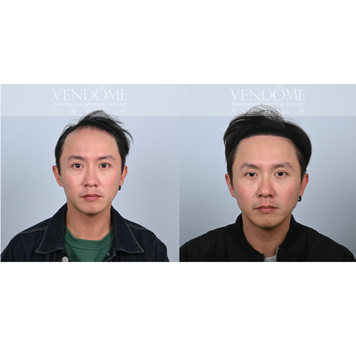 男性M型髮際線