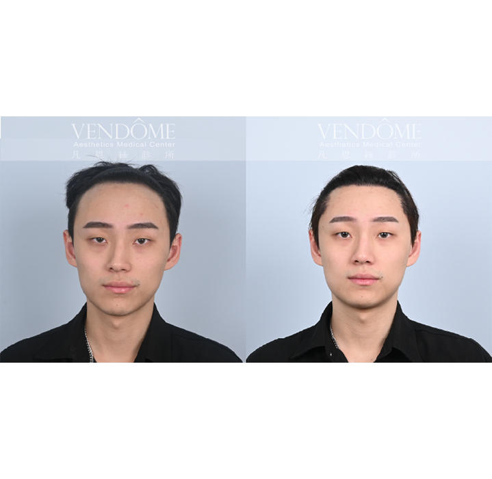 男性M型髮際線