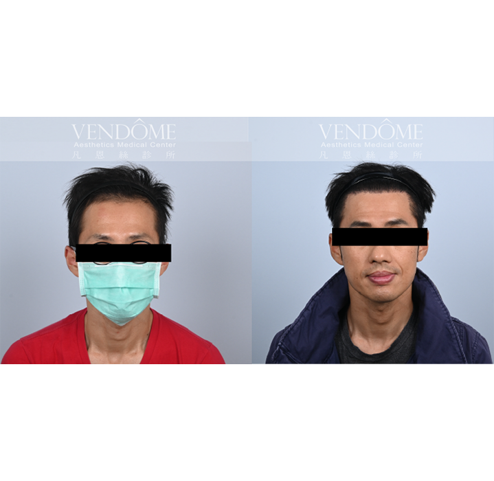 男性M型髮際線