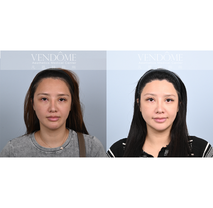 女性美型髮際線
