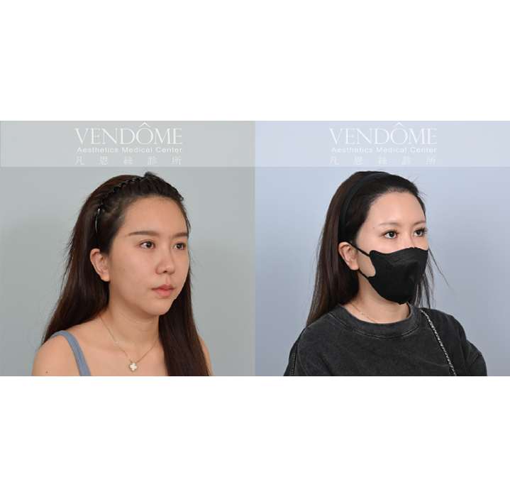女性美型髮際線