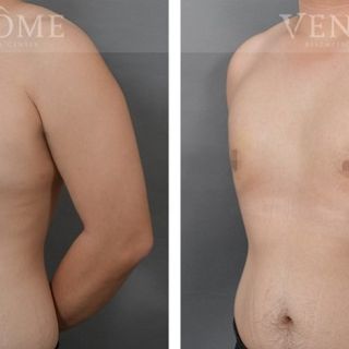 術前女乳形狀明顯，乳房外側凸出，術後變得平坦，外側線條也變得平順