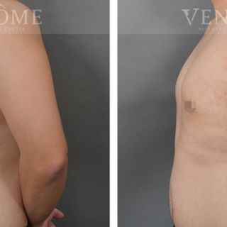 術前女乳形狀明顯，乳房外側凸出，術後變得平坦，外側線條也變得平順