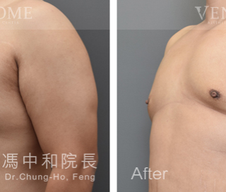 此案例在術前被醫師歸類為略為下垂的大罩杯男性女乳，在做完進階男性女乳手術後，胸部不僅變平坦也往上拉提