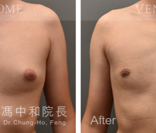 此案例在術前可看到激凸情況明顯，在做完進階男性女乳手術後，胸部已變得平坦