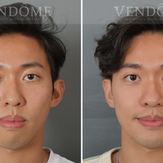 療程效果因人而異，上圖為下巴後縮合併顏面歪斜案例實際進行正顎手術術後之成效。