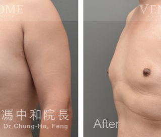 此案例在術前可看到激凸情況明顯，在做完進階男性女乳手術後，胸部已變得平坦