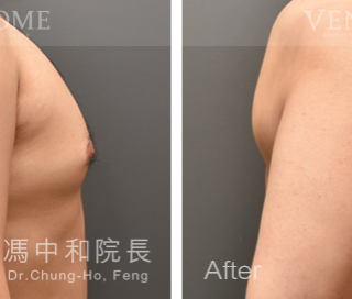 此案例在術前可看到激凸情況明顯，在做完進階男性女乳手術後，胸部已變得平坦