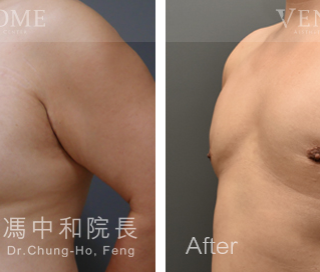 大罩杯的男性女乳，在做完進階男性女乳手術後，胸型、胸下緣均改善平坦很多
