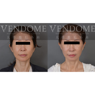 54歲女性 進行中下臉拉合併補脂 膨潤蘋果肌 解決法令紋 木偶紋與其她臉部細紋困擾 臉部整體潤澤感年輕化