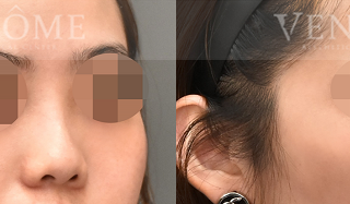 療程效果因人而異，上圖為該案例實際進行隆鼻手術術後之成效