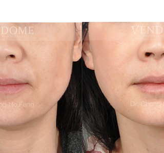 療程效果因人而異，上圖為該案例實際進行自體脂肪填補手術術後之成效