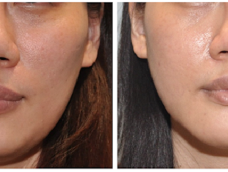 療程效果因人而異，上圖之案例深受顴骨過寬的問題困擾許久，接受顴骨塑形手術，術後一個月回診已消腫不少。