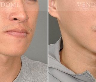 療程效果因人而異，上圖為戽斗合併顏面歪斜案例實際進行正顎手術術後之成效。