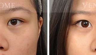 療程效果因人而異，上圖為該案例實際進行隆鼻手術術後之成效