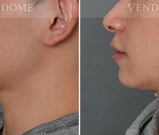 療程效果因人而異，上圖為戽斗案例實際進行正顎手術術後之成效。