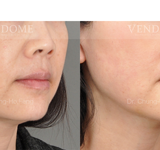 療程效果因人而異，上圖為該案例實際進行自體脂肪填補手術術後之成效