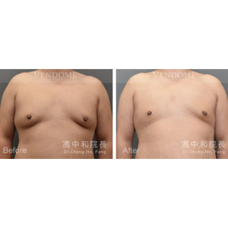 此案例在術前被醫師歸類為略為下垂的大罩杯男性女乳，在做完進階男性女乳手術後，胸部不僅變平坦也往上拉提