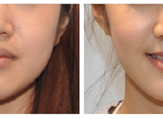 療程效果因人而異，上圖之案例是在接受正顎手術的同時，將下顎骨角做適當的修飾，把比較大的下顎骨角移除，以正顎手術處理戽斗問題，並輔以削骨手術調整臉部比例。