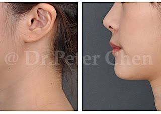 療程效果因人而異，上圖為下顎骨突出(戽斗)案例實際進行正顎手術術後之成效。