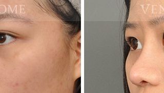 療程效果因人而異，上圖為該案例實際進行隆鼻手術術後之成效