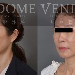 54歲女性 進行中下臉拉合併補脂 膨潤蘋果肌 解決法令紋 木偶紋與其她臉部細紋困擾 臉部整體潤澤感年輕化