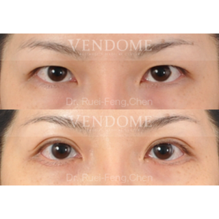 療程效果因人而異，上圖為該案例實際進行縫雙眼皮手術術後之成效