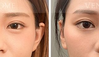 療程效果因人而異，上圖為該案例實際進行隆鼻手術術後之成效