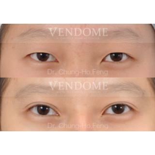 療程效果因人而異，上圖為該案例實際進行割雙眼皮手術術後之成效