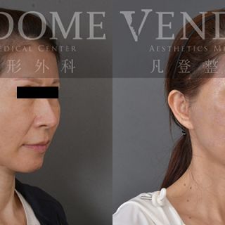 54歲女性 進行中下臉拉合併補脂 膨潤蘋果肌 解決法令紋 木偶紋與其她臉部細紋困擾 臉部整體潤澤感年輕化