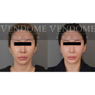 35歲女性 進行中下臉拉皮 強化下巴與下顎整體V型曲線立體感 改善臉部細紋