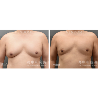大罩杯的男性女乳，在做完進階男性女乳手術後，胸型、胸下緣均改善平坦很多