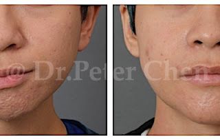 療程效果因人而異，上圖為顏面歪斜合併下顎骨後縮案例實際進行正顎手術術後之成效。