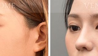 療程效果因人而異，上圖為該案例實際進行隆鼻手術術後之成效