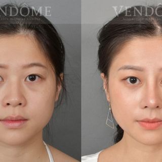 療程效果因人而異，上圖為該案例實際進行隆鼻手術術後之成效