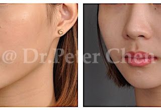 療程效果因人而異，上圖為案例實際進行顴骨截骨內推合併下巴截骨手術術後之成效