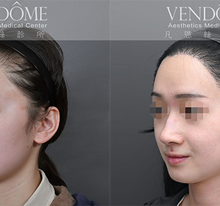 美型髮際線植髮不只是補毛，更能明顯提升臉部的立體感和年輕度。醫師會考量額頭比例、臉型輪廓以及整體氣質，設計出最適合的髮際線形狀，強調自然且具有美感。  適合追求精緻外觀、希望臉部輪廓更和諧的族群，彌補原本髮際線不對稱或線條不理想的缺陷。