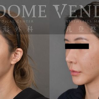 35歲女性 進行中下臉拉皮 強化下巴與下顎整體V型曲線立體感 改善臉部細紋