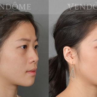 療程效果因人而異，上圖為該案例實際進行隆鼻手術術後之成效